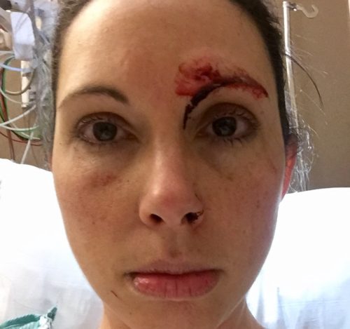 Photo of Kelly Herron took of herself, the day she was attacked in the women’s restroom at Golden Gardens Park on Sunday afternoon, March 5, 2017. (Photo courtesy of Kelly Herron)